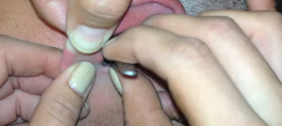 Man Finds A Tick And A Moth In His Ear And There Is Only One Way To Get It Out [NSFW VIDEO]