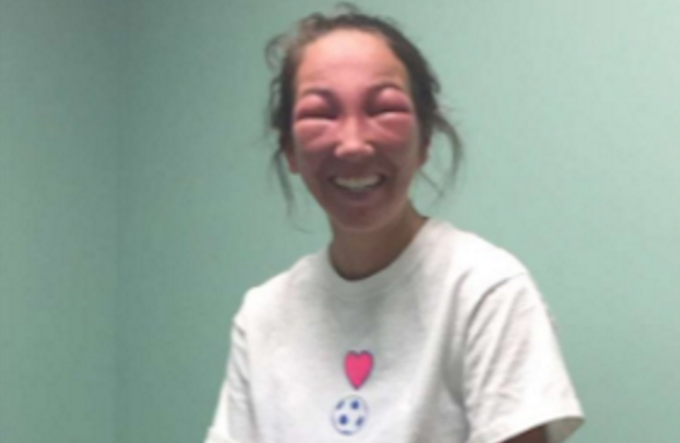 This Is What It Looks Like When You Get Poison Ivy In Your Eyes [PHOTOS]