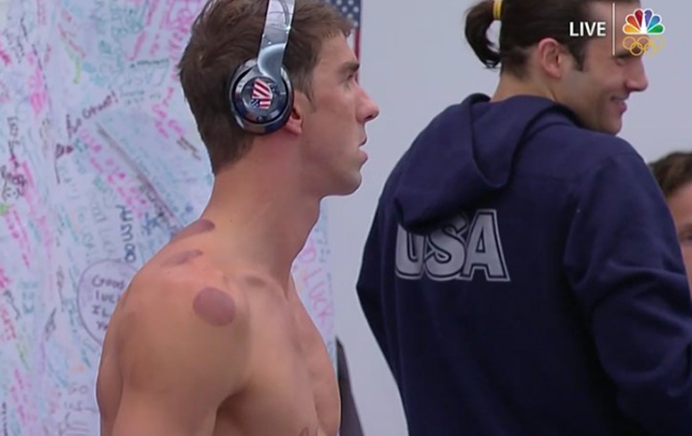 Michael Phelps Resorts To Cupping Therapy, Leaves Bruises On Body