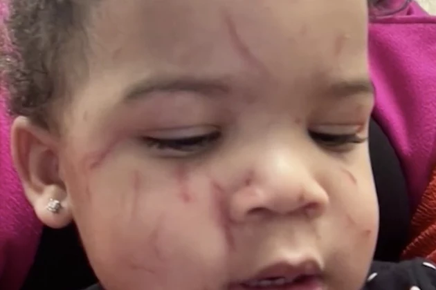 Mother in Louisiana Says Her Baby Was Attacked at Daycare [VIDEO]