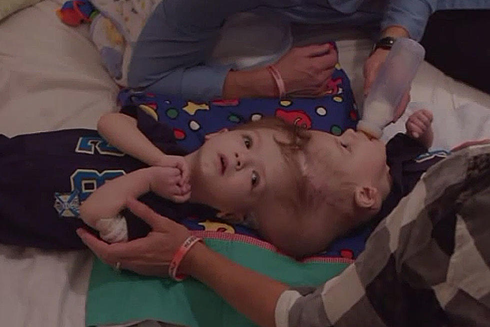 Doctors Successfully Separate Conjoined Twins