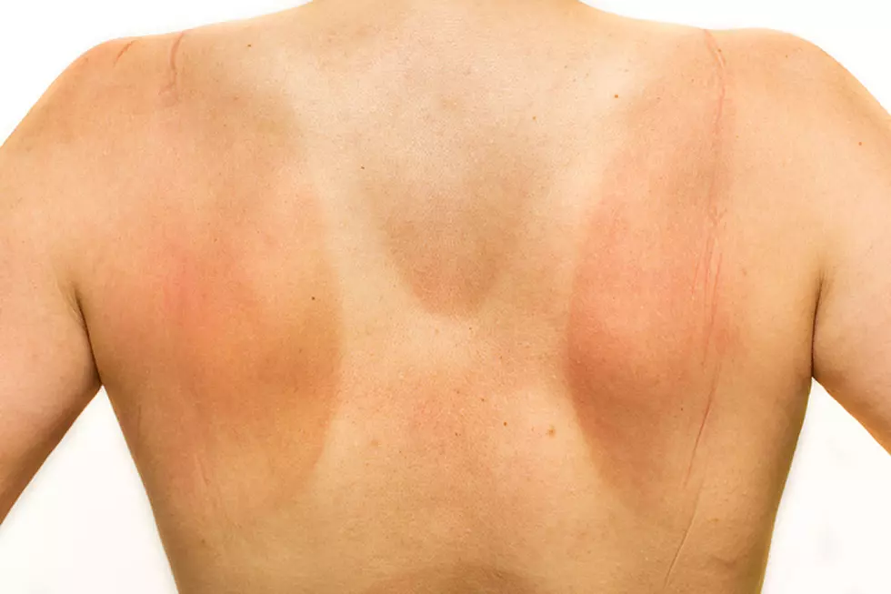 These Awful Tan Lines Will Have You Running for Shade