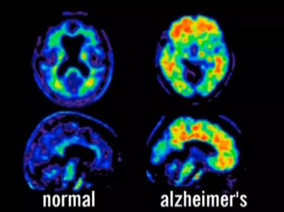 Study Looks For Link In Childhood Blood Sugar Levels &#038; ALZ