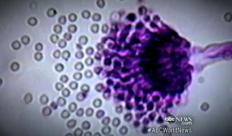 40 Cases Of Fungal Meningitis Now Reported In NJ