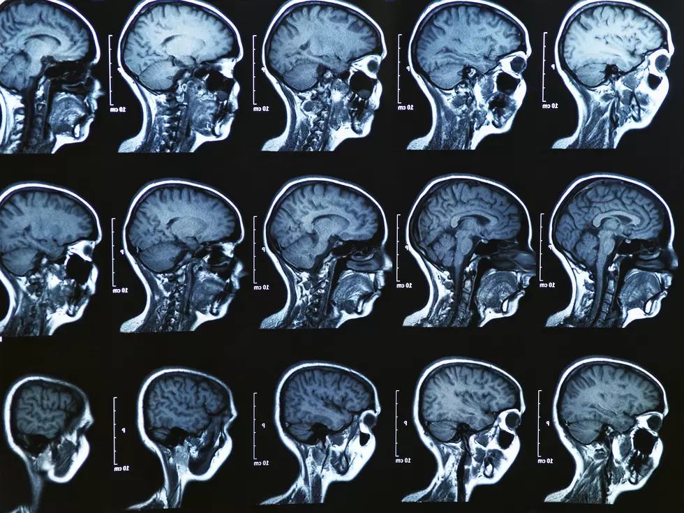 Brain scans find protein a marker of Alzheimer’s decline