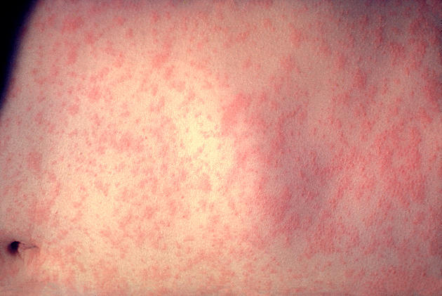 Measles may have been spread at Newark Airport, Englewood