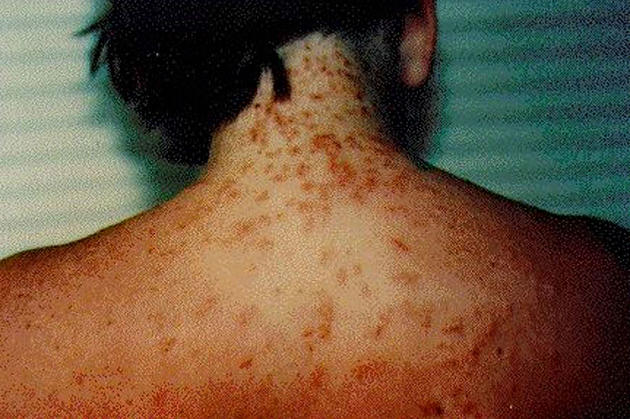 &#8216;Sea Lice&#8217; Make for an Itchy Trip to the Jersey Shore