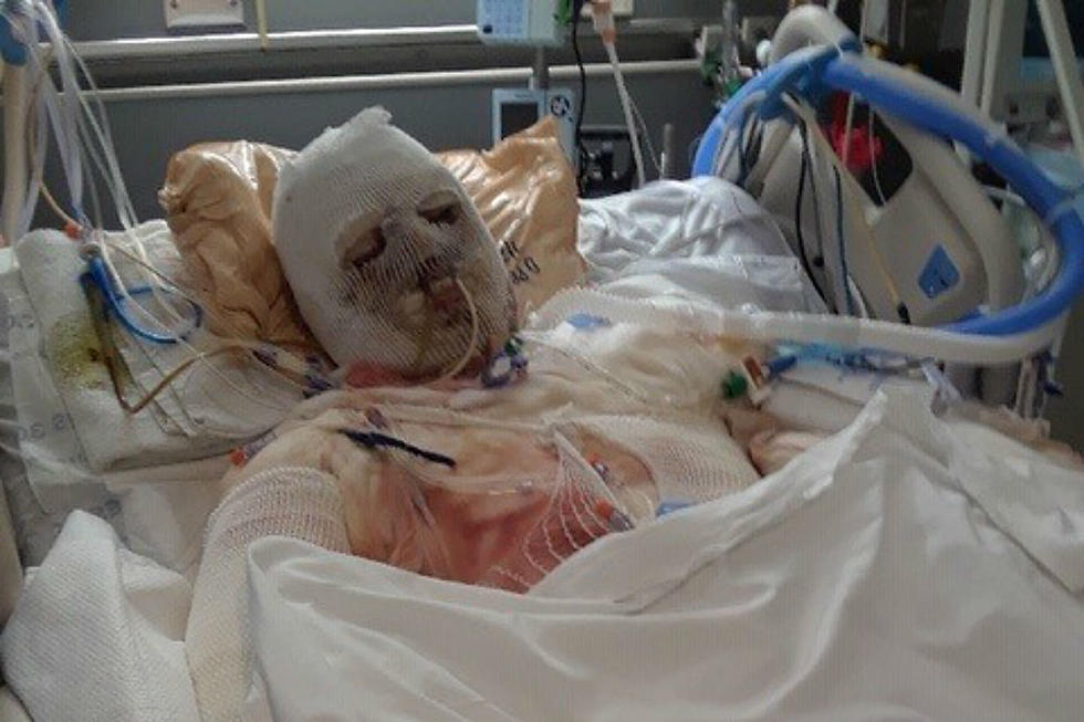 Union County man severely burned in car crash hopes to drive again