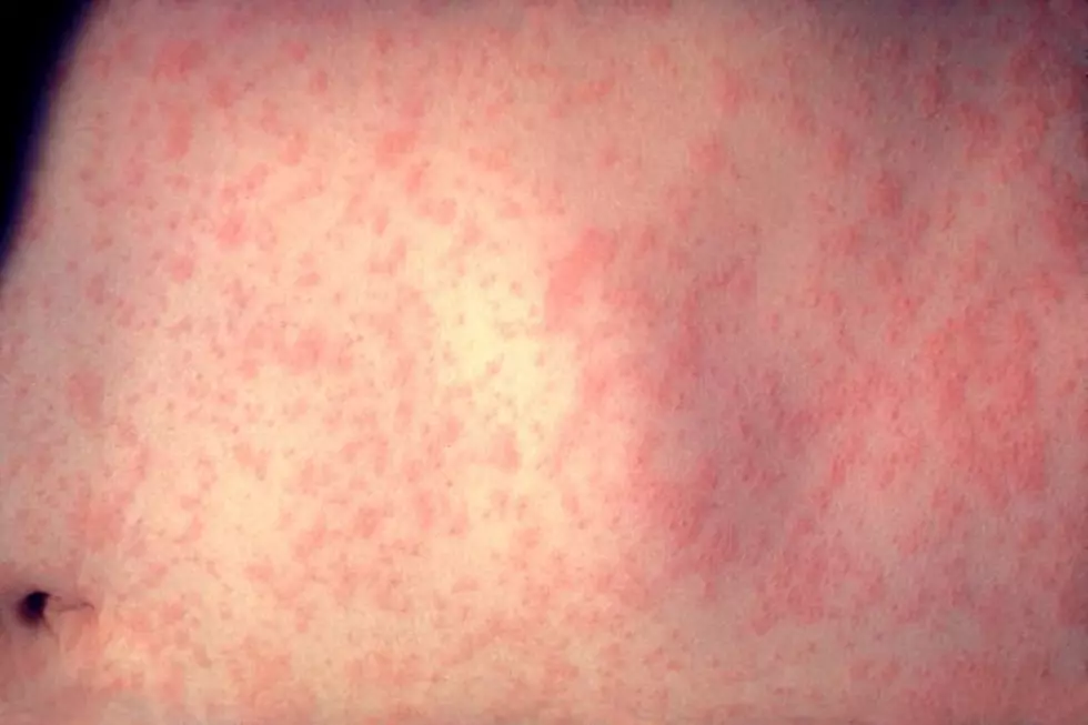 Measles at NJ school — months after outbreak ended