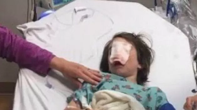 Boy Lost Nose After Dog Attacked Him on Wildwood Beach, Supporters Say
