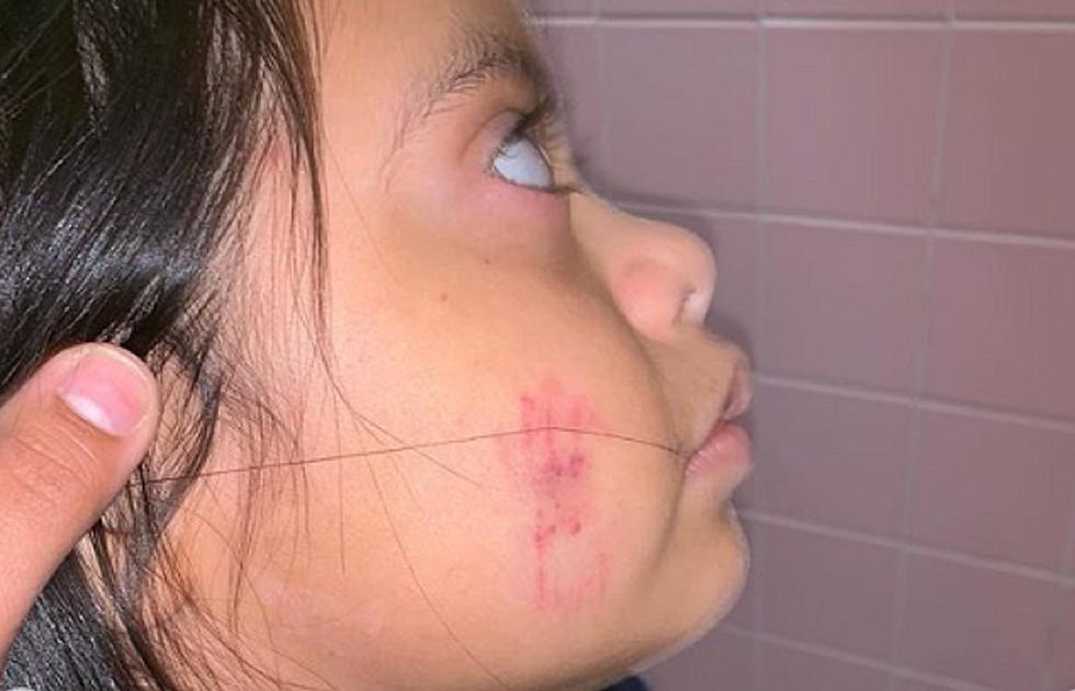 NJ special-needs girl&#8217;s first day of school: Bite marks all over body