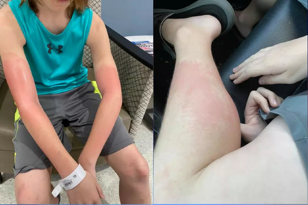 Bergen County Boy Burned by Hand Sanitizer Sold at 7-Eleven, Mom Says