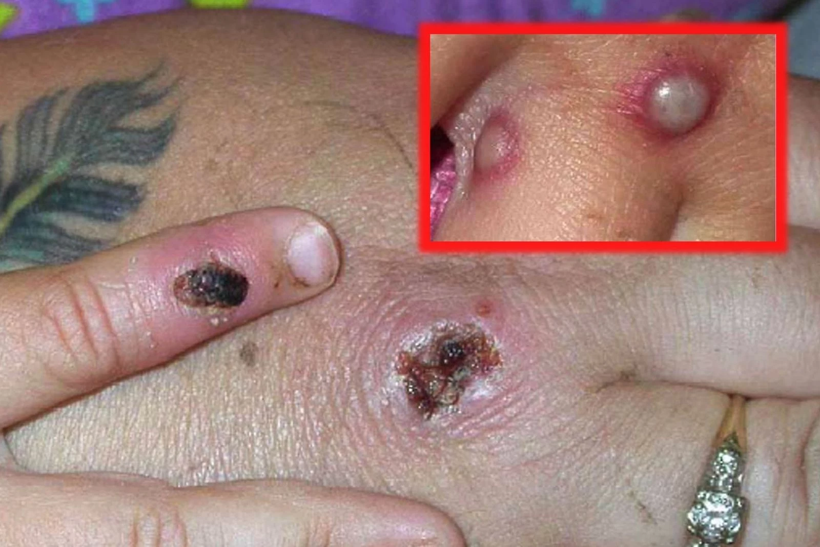 Monkeypox: Ultimate FAQ — symptoms, last . outbreak, treatment