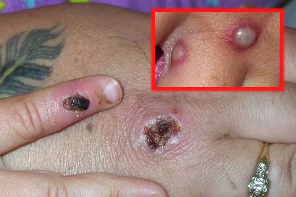 Monkeypox: Ultimate FAQ — symptoms, last U.S. outbreak, treatment