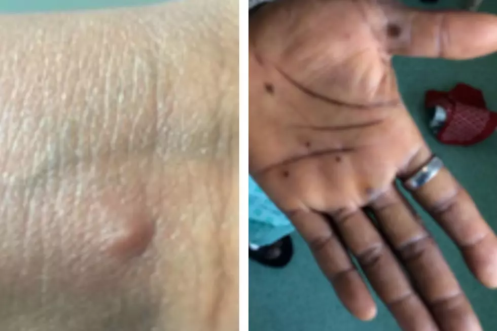 Woman with 'Extremely Painful' Monkeypox Says She Wasn't Offered Vaccine
