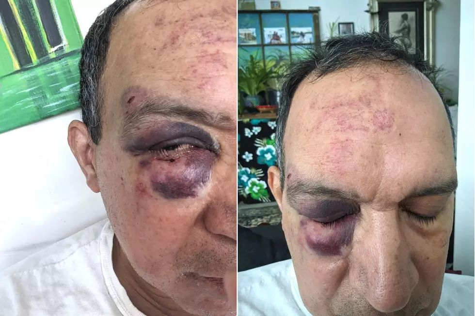 Head and facial injuries Lopez suffered in an assault at the Bordentown Best Western on 8/20/2022. (Chris Lopez)