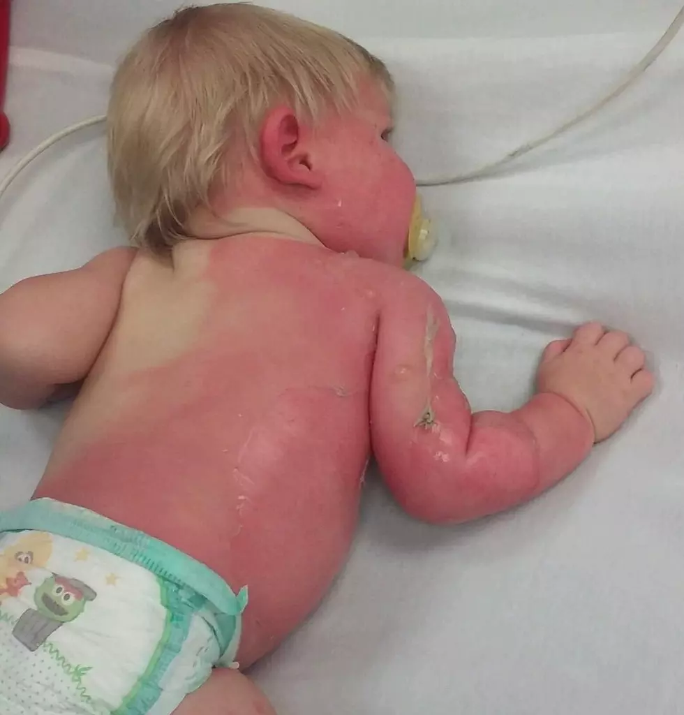 Garden Hose Water Warning After Baby Suffers Severe Burns