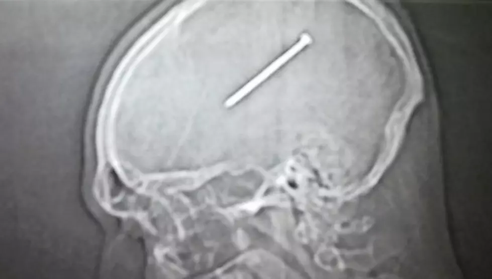 Man Doesn&#8217;t Notice He Shot a Nail Into His Skull