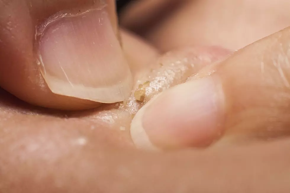 Watch a Monstrous Puss-Filled Zit Popping and Prepare to Never Sleep Again