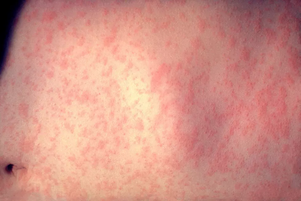 2nd suspected measles case reported in South Jersey