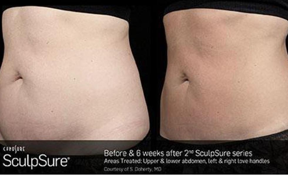 Got Fat? Try Sculpsure (WATCH THIS VIDEO)