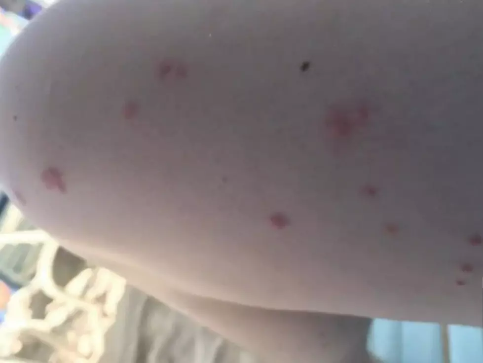 Sea Lice Are Back on South Jersey Beaches: What You Should Know