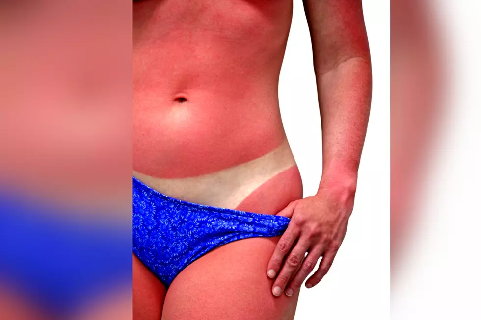 Excuses That a Sunburn Is OK