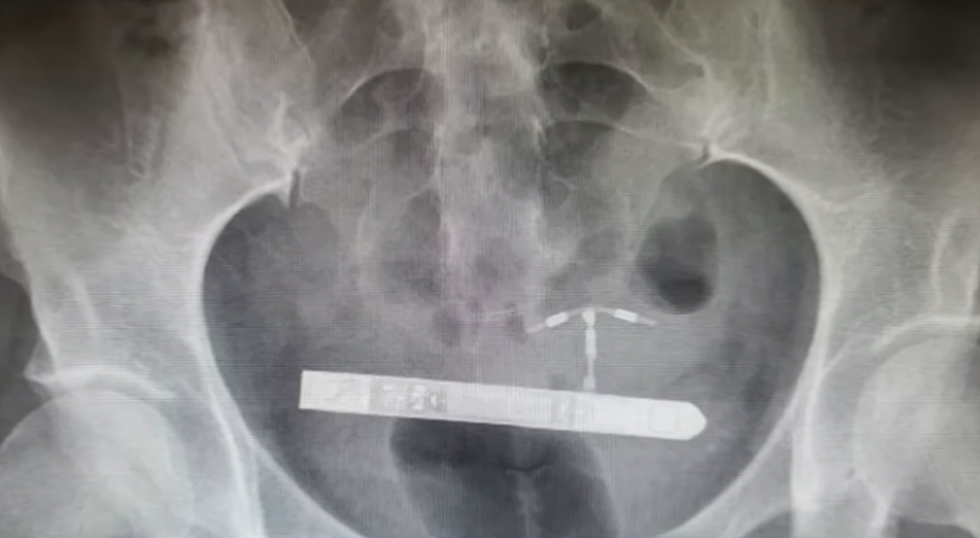 Woman Needs Emergency Surgery To Remove Her Vibrator From Her Bladder!