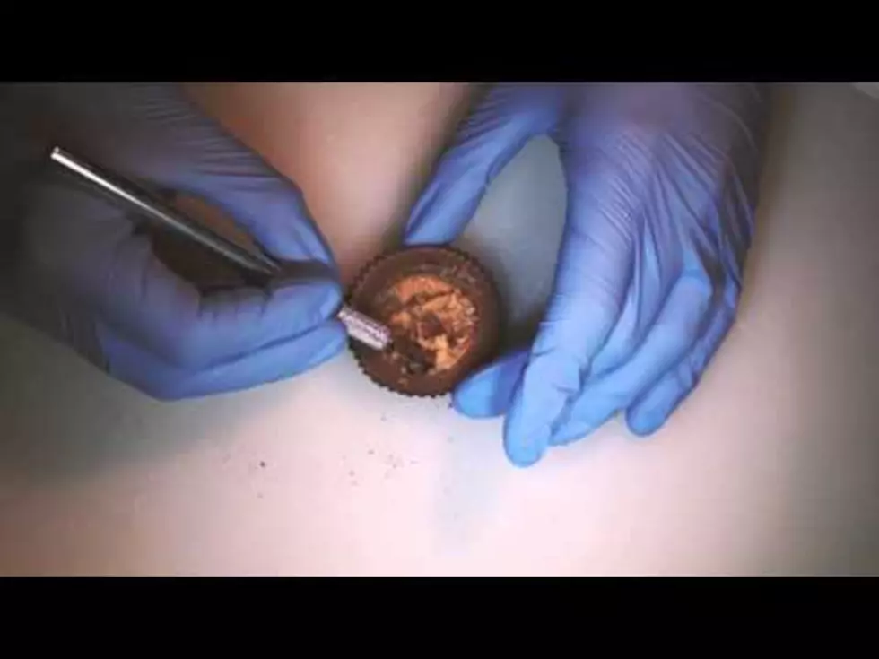 YouTube&#8217;s Food Surgeon Attempts Reese&#8217;s Peanut-Butter-Ectomy With Oreo Cream Transplant [Video]
