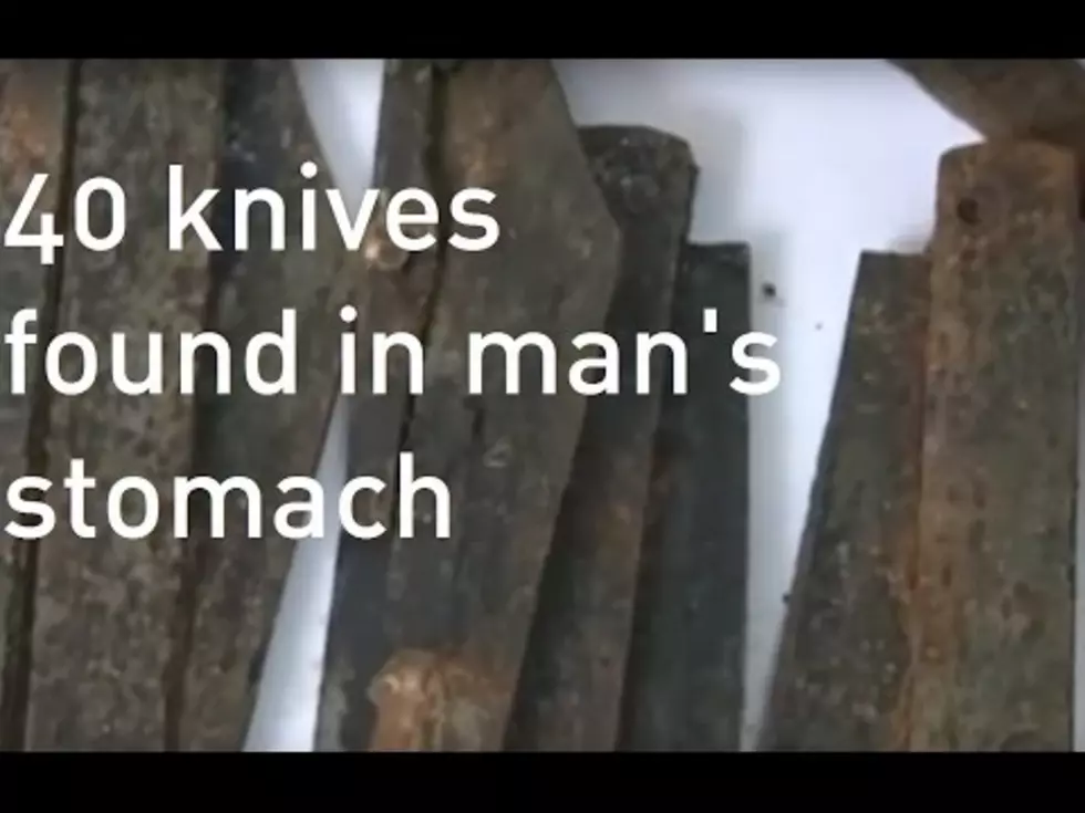 Doctors Remove 40 Knives from Man's Stomach