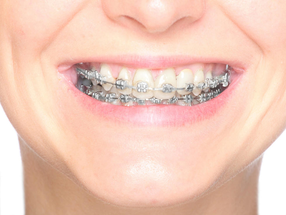 Check Out This Timelapse Of Braces Straightening Teeth [Video]