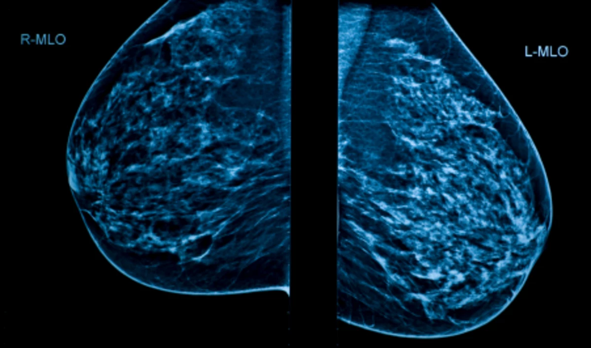 mammogram mammography breast computer aided digital zero
