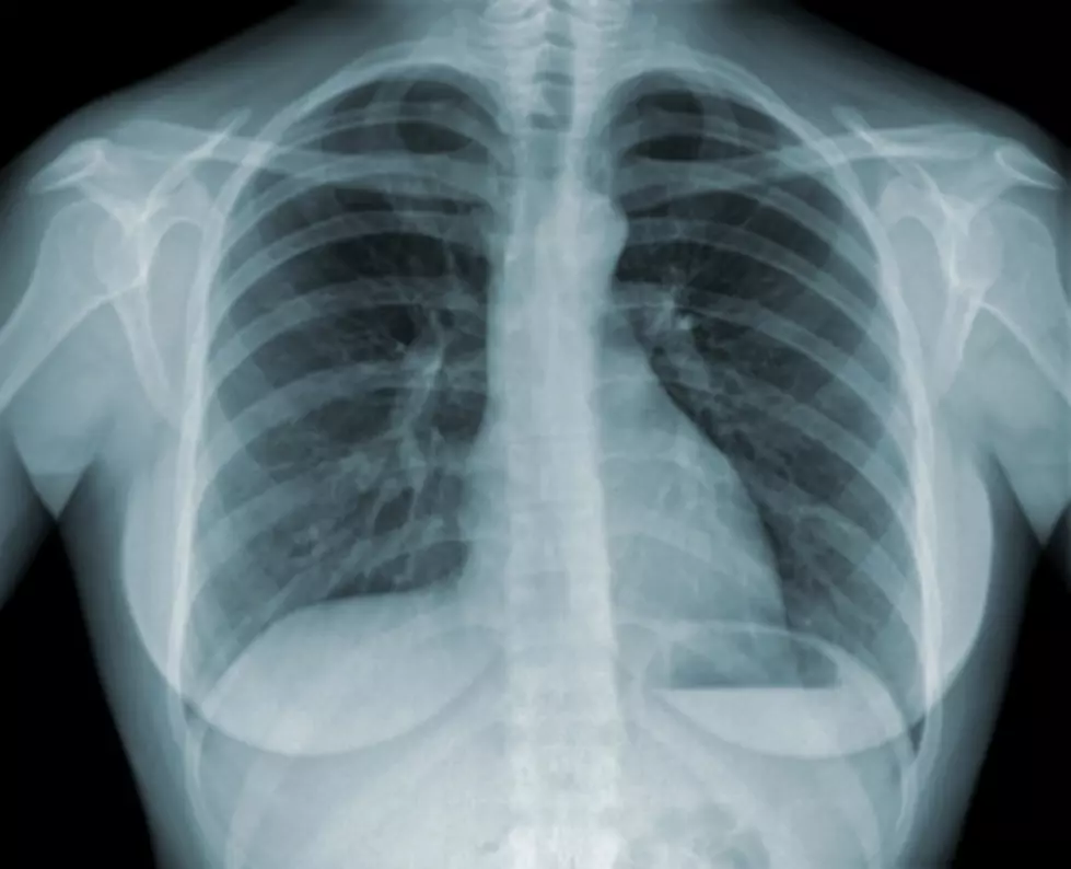 Lung Cancer Survival Rates Report Released