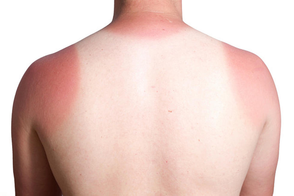 What&#8217;s the Best Relief for Sunburn?