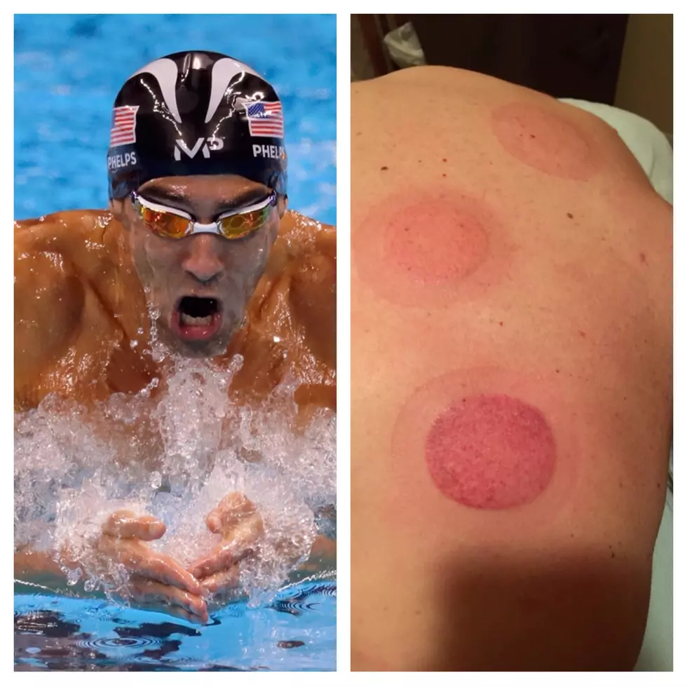 Todd’s Wife Jenny Shows How Cupping Helps Her and Michael Phelps