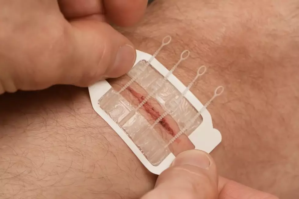 New Device Eliminates The Need For Traditional Stitches