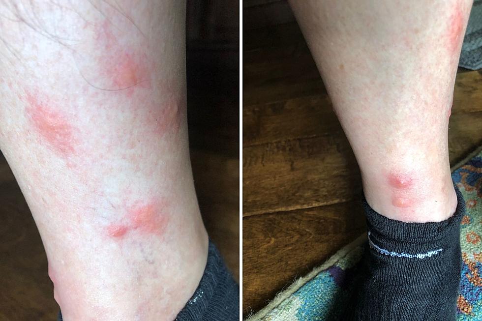 Who Else Gets Red, Itchy, Welts from Bug Bites?