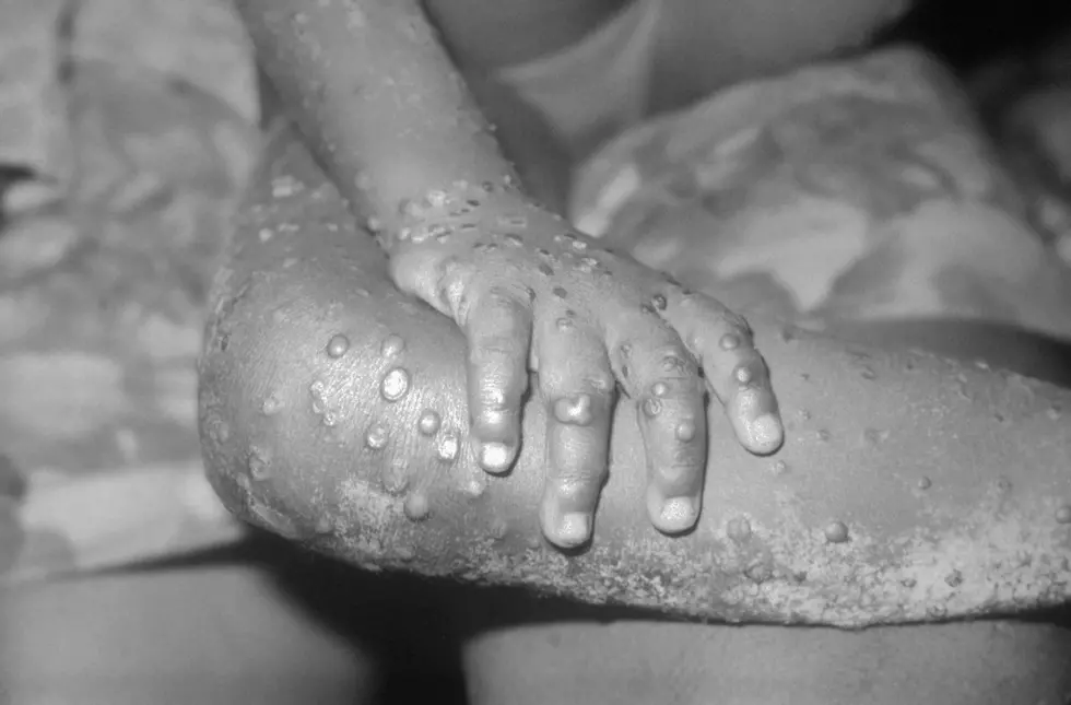 Monkeypox Arrives in South Dakota