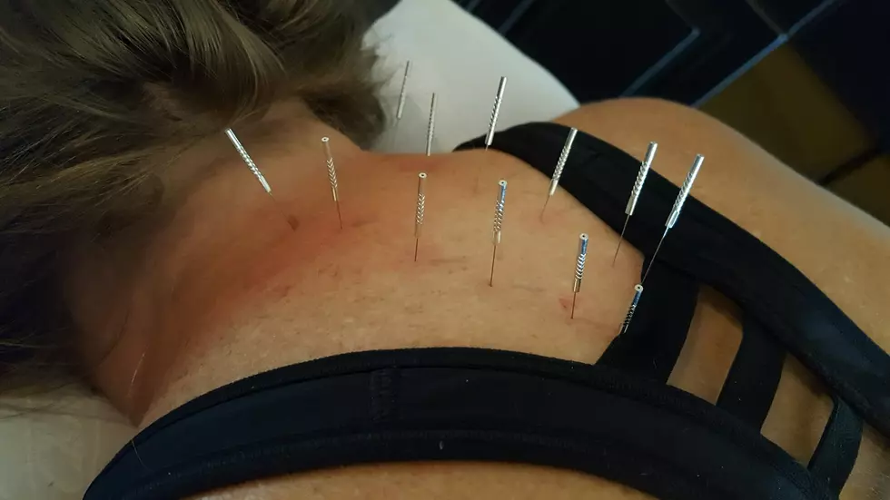Dry Needling to Relieve Pain, Kama Gives it a Try
