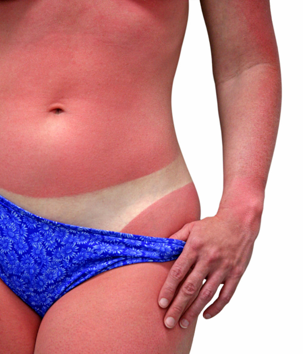 Does This Guy Have The Worst Sunburn Ever? [VIDEO]