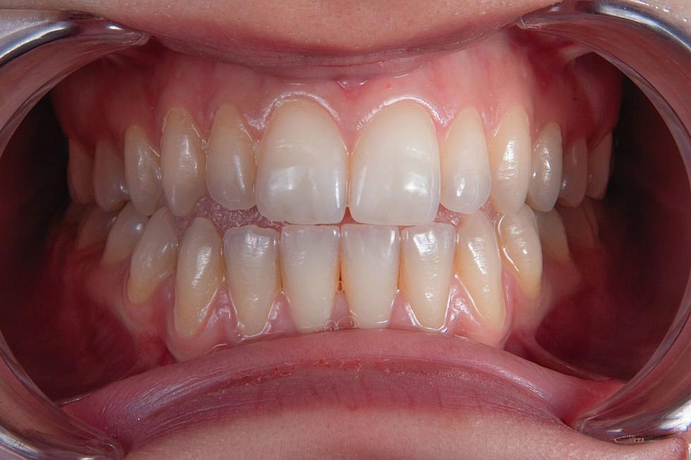 Mainers Are More Likely to Have Discolored Teeth