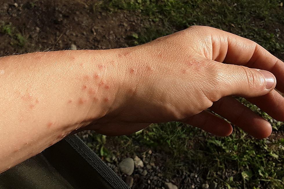 My Browntail Moth Caterpillar Rash Is Making Life In Bangor Miserable