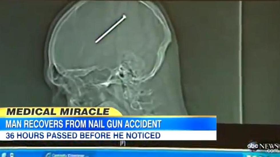 Man Lives To Joke About a Nail Lodged Inside His Brain for 36-Hours