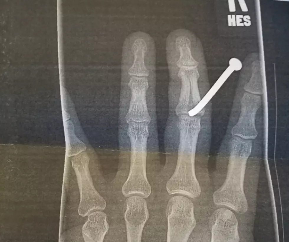 Nailed It: Greeley Deputy Gets Nail Stuck in Finger