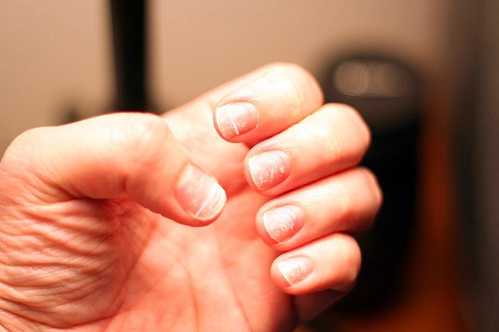 White Spots on Your Nails?
