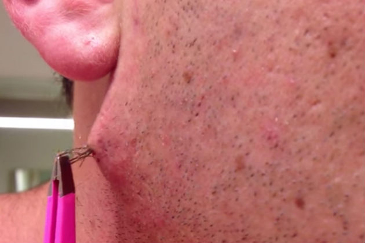 This Guy S Ingrown Hair Is Absolutely Insane Video