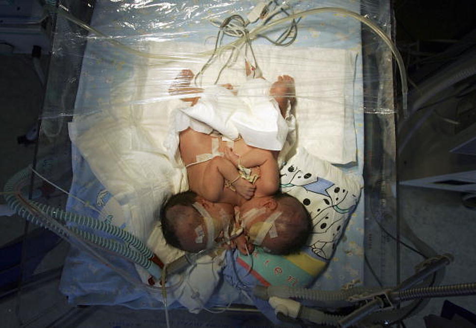 Conjoined Twin Dies After Separation Procedure At Children’s Hospital Colorado