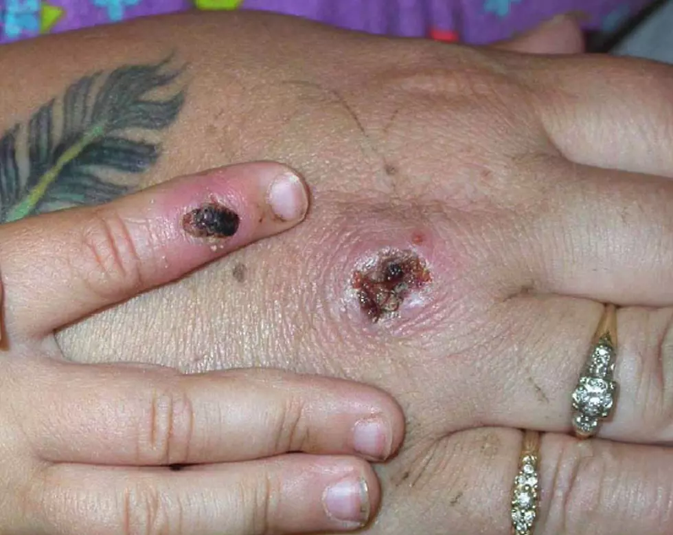 Yikes! Central Texas Please Be Cautious Of Monkey Pox They Are Real