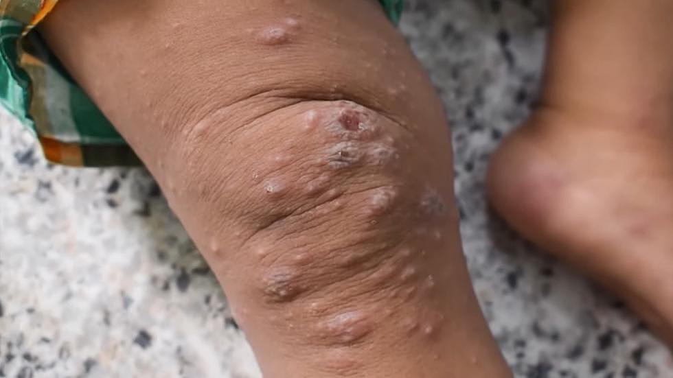 This Is What Texans Need To Know About The First Pediatric Case of Monkeypox In Texas