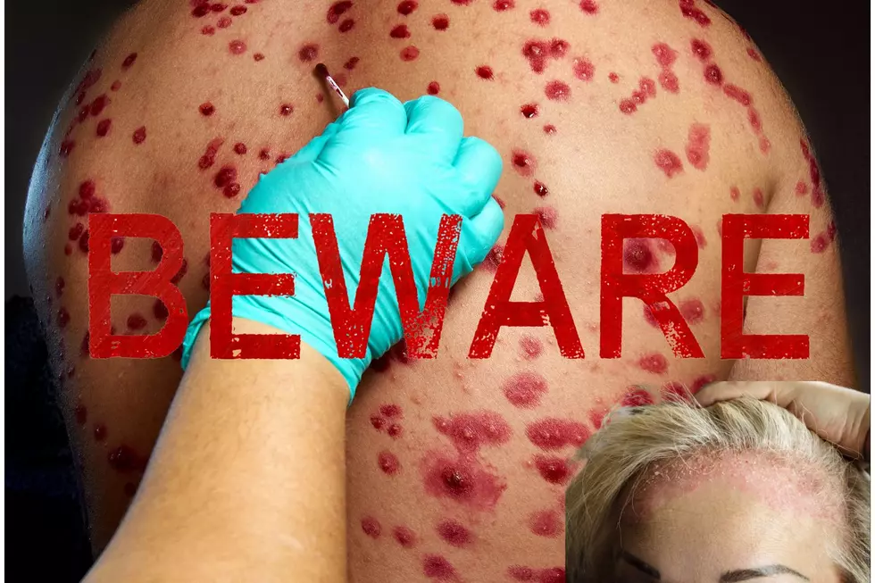BEWARE! Parasitic Skin Disease Is Spreading In The US, Here’s What Texas Needs To Know!